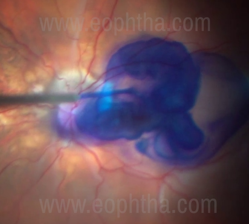 Figure-1 Intraoperative picture showing striking contrast of BBG dye against orange fundus in a myopic eye.