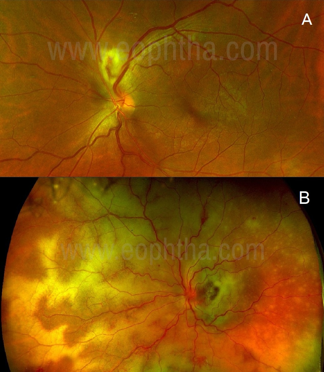 1036px x 1188px - An Approach to a Case of Retinitis