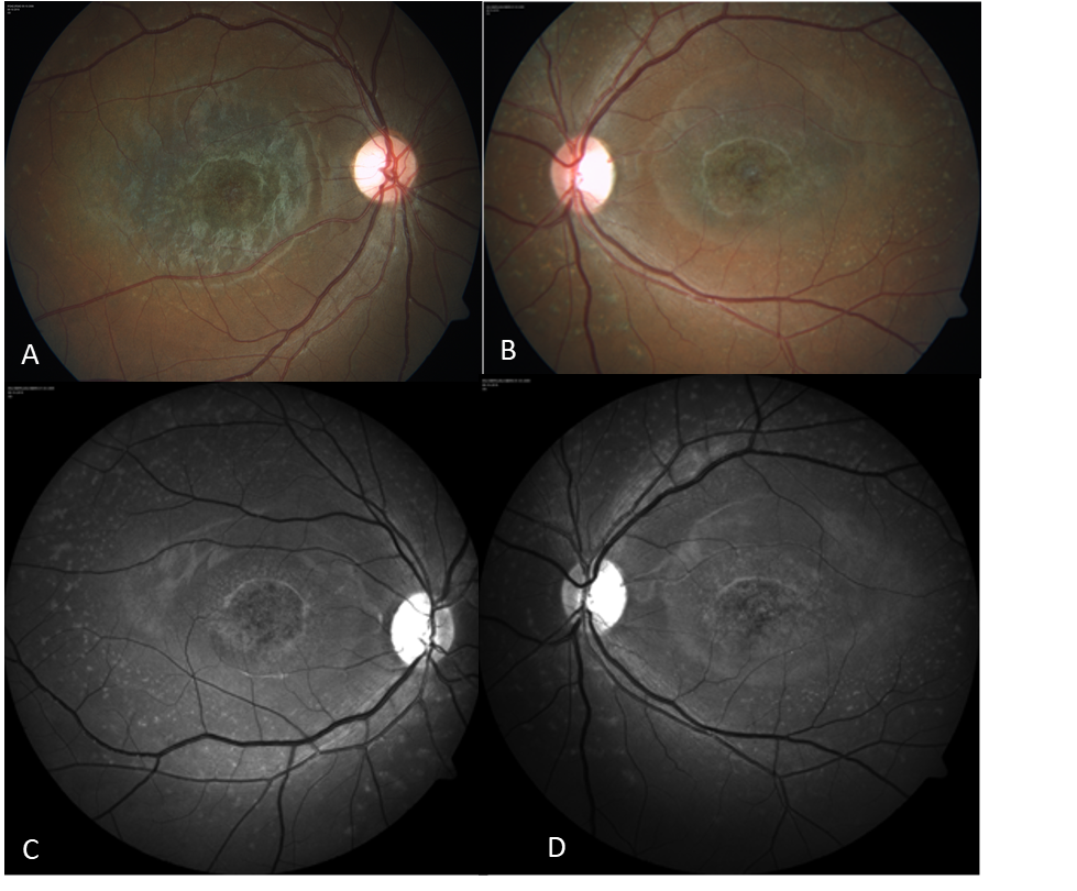 Understanding Optic Disc Pallor Shades Of White 